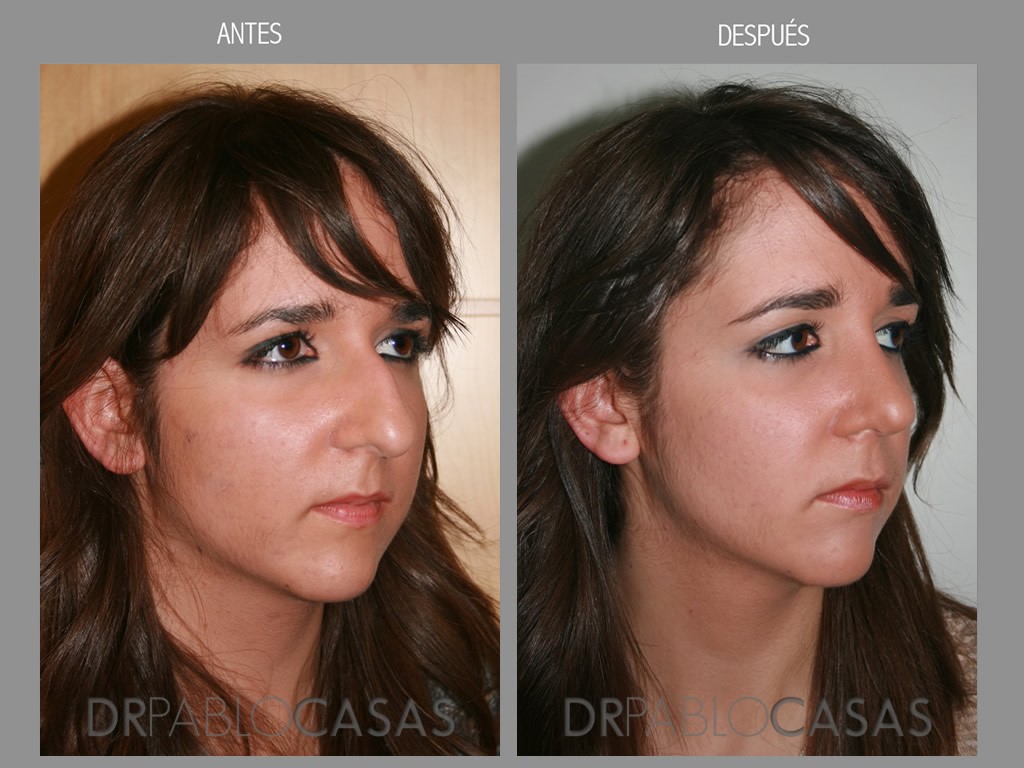 rinoplastia