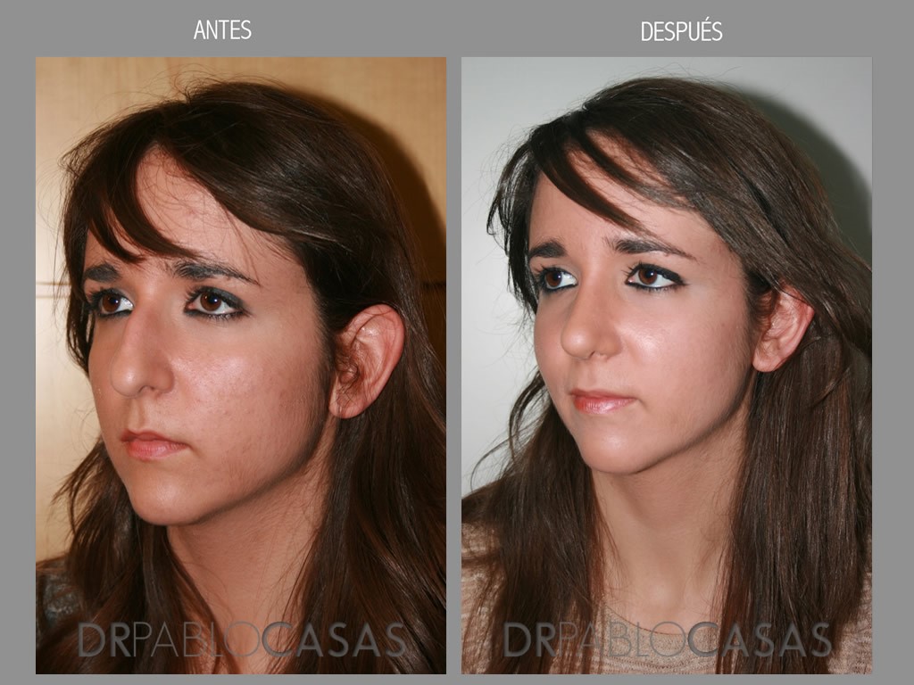 rinoplastia