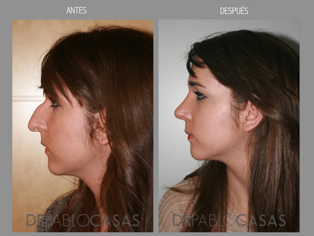 rinoplastia