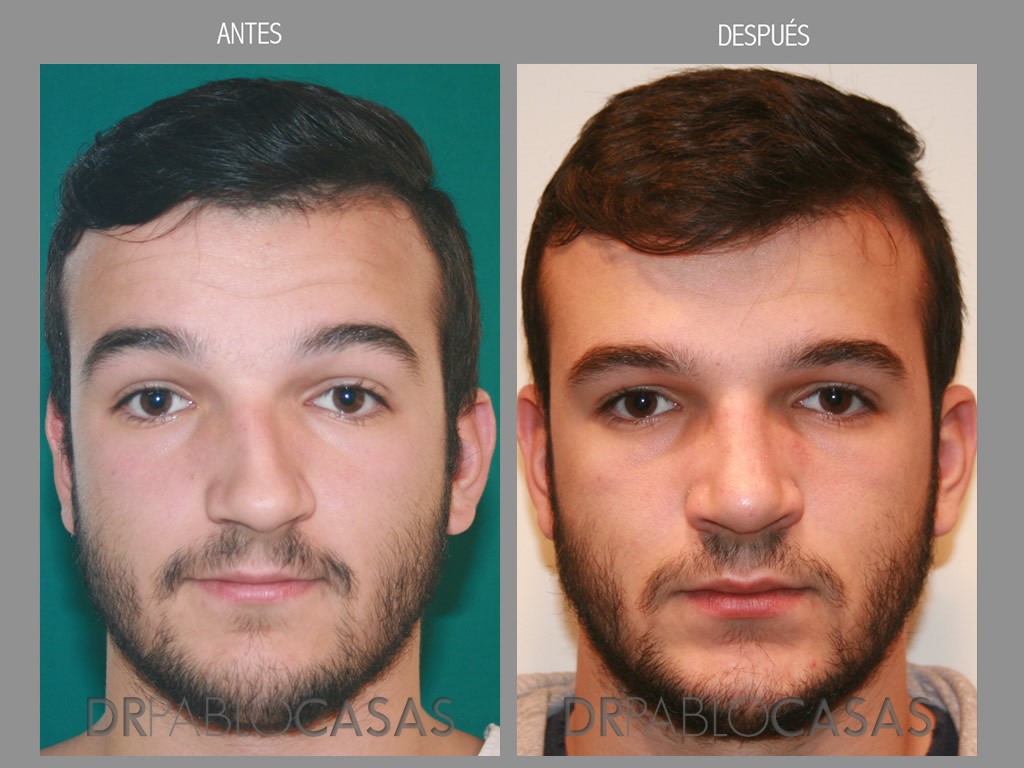rinoplastia