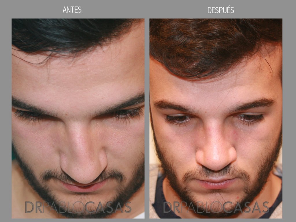 rinoplastia