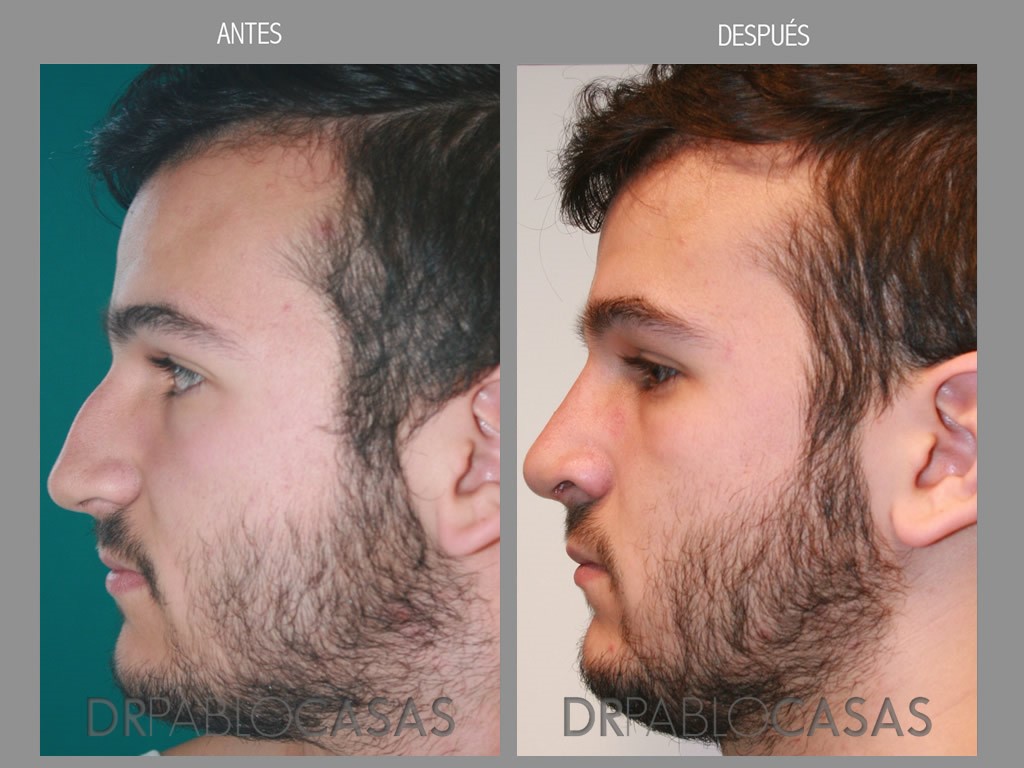 rinoplastia